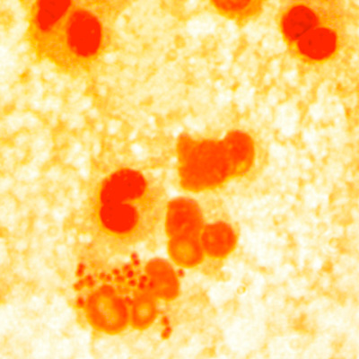 Tudtad-e, hogy a gonorrhoea (tripper, kankó, gatyabaj)…